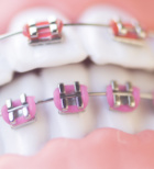 יישור שיניים עם חוטי מתכת - תמונת אווירה